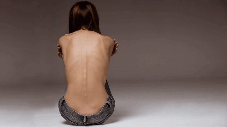 Signos de alarma para detectar anorexia, bulimia y otros trastornos alimentarios