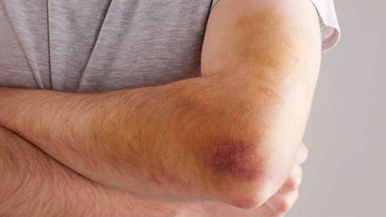 6 razones por las que pueden aparecer moretones en la piel