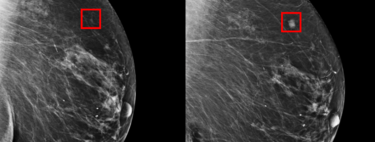 La Inteligencia Artificial ya permite detectar un cáncer de mama con hasta cinco años de anticipación 