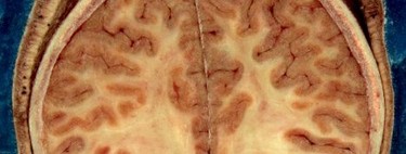 Nueva técnica para suprimir los efectos de la esquizofrenia: resincronización de neuronas 