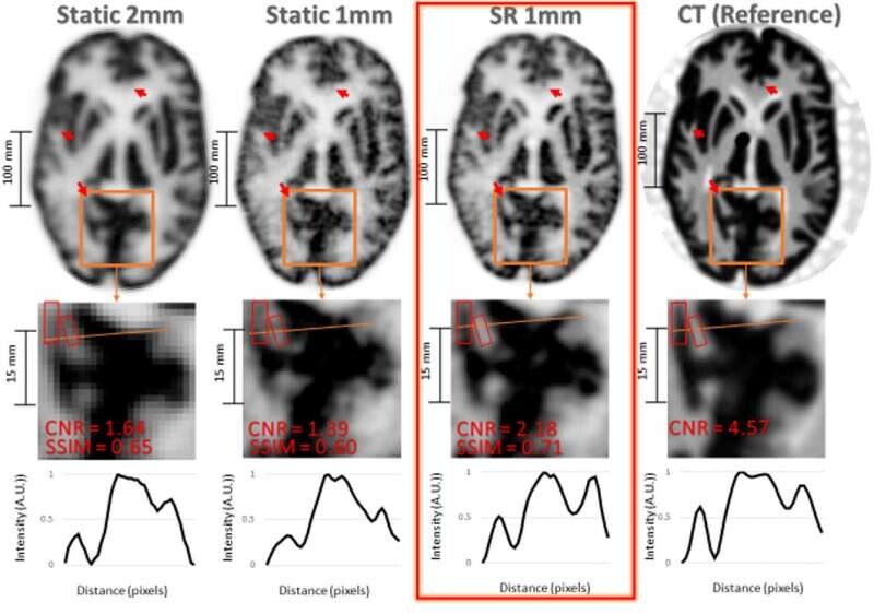 Esta nueva técnica de superresolución permite obtener imágenes cerebrales más detalladas y podria detectar el Alzheimer