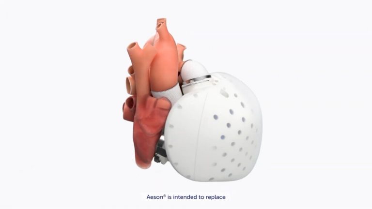 Se realiza el primer implante de corazón artificial humano Aeson en los Estados Unidos, como parte de un estudio clínico