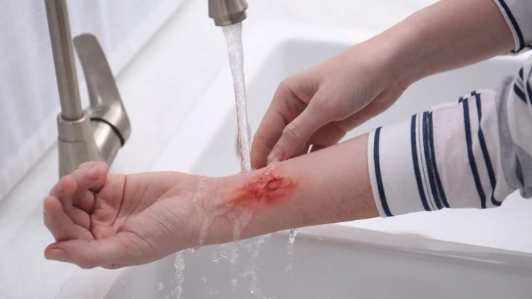 ¿Cómo tratar las quemaduras de forma natural?