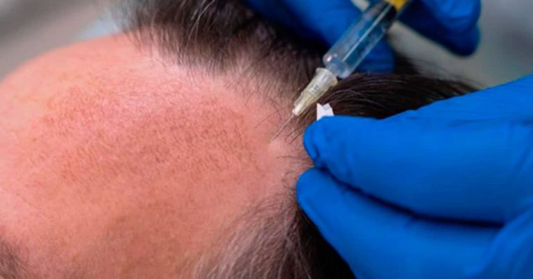 Innovaciones en el tratamiento de la alopecia: Medicamentos y avances recientes