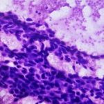 Imagen-de-un-tumor-mamario-que-muestra-carcinoma-ductal.-iStock-300×229-1