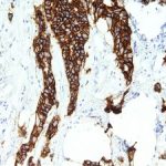 800px-Her_2_staining_on_patient_breast_cancer_tissue_identified_as_stage_3-300×225-1